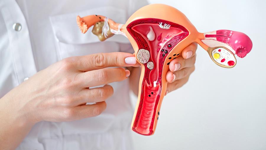 Une étude de cohorte précise l’association entre fibromes utérins et risque de fausse couche tardive